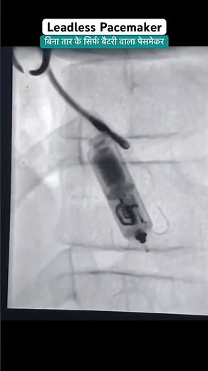 Leadless Pacemaker l Slow heart beat Treatment #ecg #heartblock #shorts