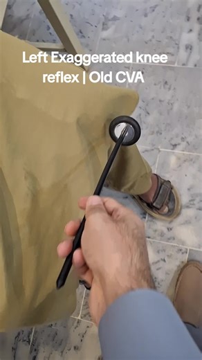 Left Exaggerated knee reflex | Old CVA