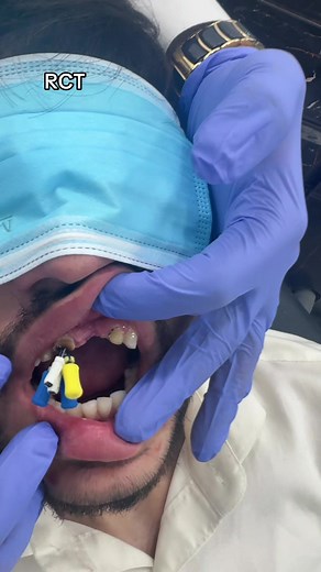 RCT: Root Canal Treatment Explained