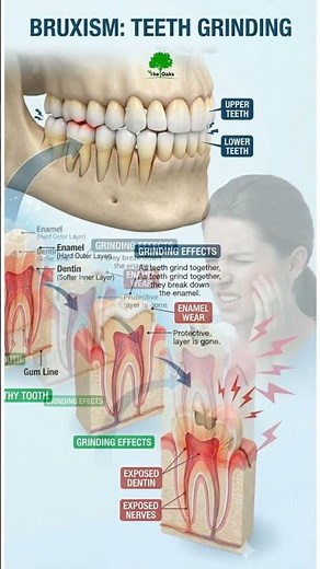 Teeth Grinding (Bruxism) Explained 😬🦷