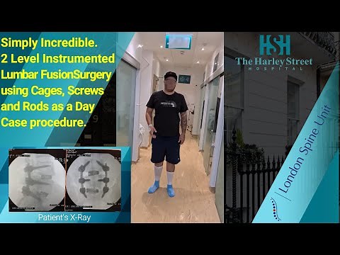 2 Level Instrumented Lumbar Fusion Surgery using Cages, Screws as a Day Case.
