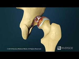 Total Hip Replacement