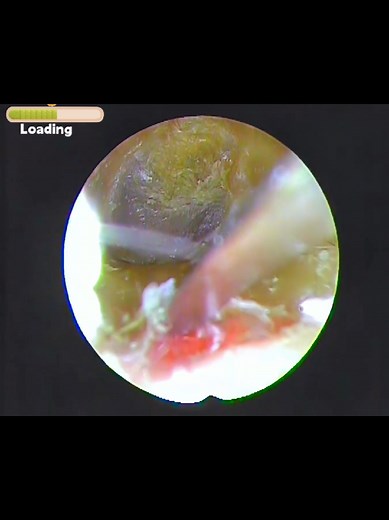 Your ears have seen some things...and now they're finally free #asmr #earcleaning #notalkingasmr #povasmr #satisfying