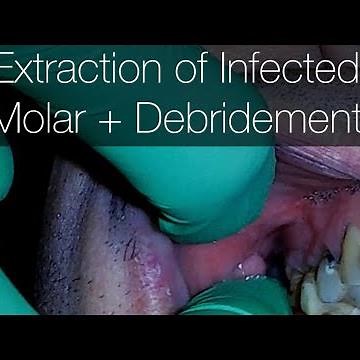 Removal of Granulation Tissue after Molar Extraction