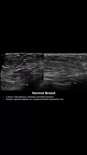 Normal Breast Anatomy Ultrasound | Subcutaneous, Retromammary Zones/Cooper Ligaments | USG #shorts