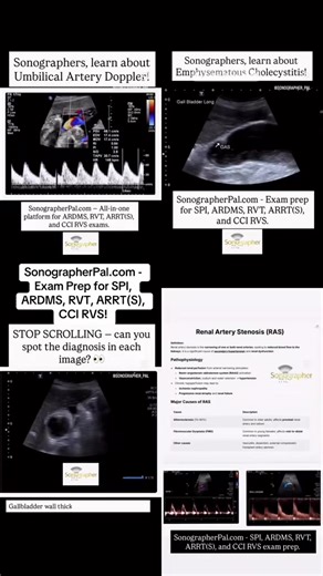LINK IN BIO! What board-level detail actually looks like 👇 If you’re studying for SPI, OB/GYN, Abdomen, or Vascular boards, you already know this: Seeing a pathology is one thing. Understanding why it looks that way, what it means clinically, and how it gets tested… that’s what moves the needle. This quick clip is a snapshot of the level of detail inside SonographerPal.com — real board-focused education built for sonographers, sonography students, and educators. What you’re seeing in this video