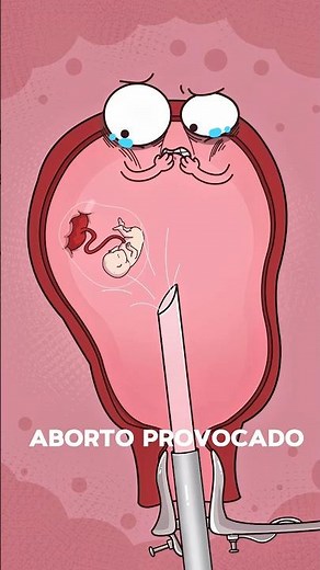 Qué ocurre durante una interrupción quirúrgica del embarazo ⚠️ #salud #fypシ #saludreproductiva