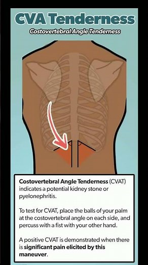 Costovertebral Angle CVA tenderness indicate kidney stone or pyelonephritis#doctor #shortsfeed#short