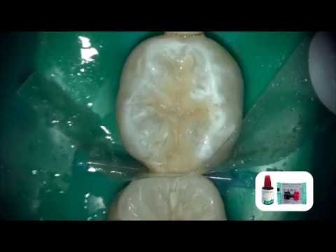 Class II Stress Bearing Restoration with EQUIA Forte