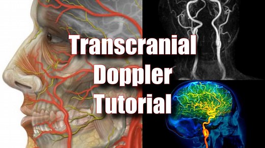 Transcranial Doppler Tutorial For Sickle Cell screening TCD's. A primer for cerebrovascular sonography!! Henry Suarez RDMS, RVT | John Z Wetmore
