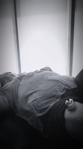 Physical therapy suction cup nerve therapy