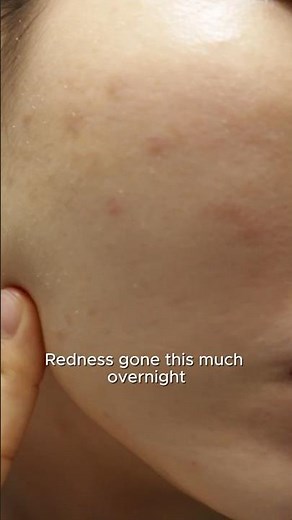 Redness? DELETED Overnight. 🤯 (My Emergency Fix) #skincare #shorts #glassskin #beauty #fyp #makeup