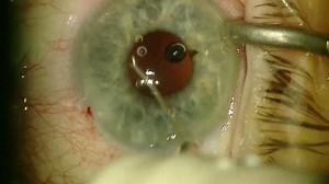 Small Pupil Phaco With iStent and ECP - Eyetube