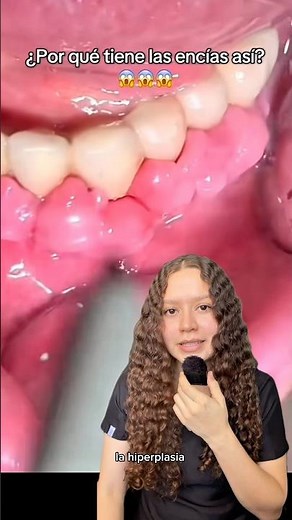 Gingival hyperplasia: What is it? #dentistry #gum #dental