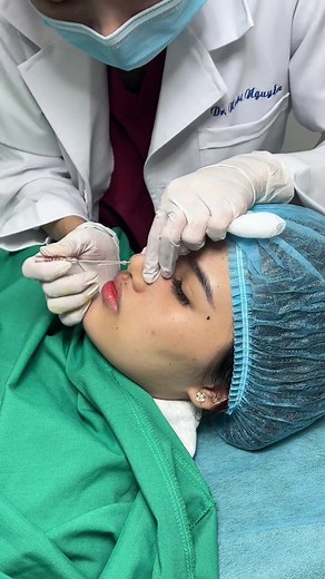 Nose lift with thread #medical #nosethreadlift | nose