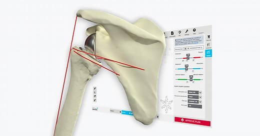 Personalized 3D Planning and Guides for Shoulder Arthroplasty