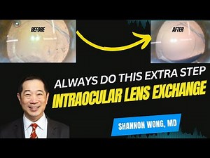 Optimizing outcomes and patient satisfaction with intraocular lens exchange - Do this one extra step