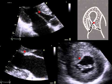 SYSTOLIC ANTERIOR MOTION OF THE MITRAL VALVE