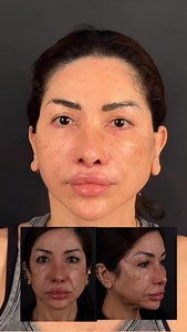 39K views · 148 reactions | Update of our beautiful patient 20 days...