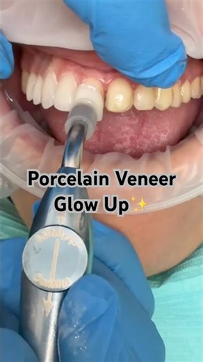 What REALLY Happens When You Get Veneers 🦷✨