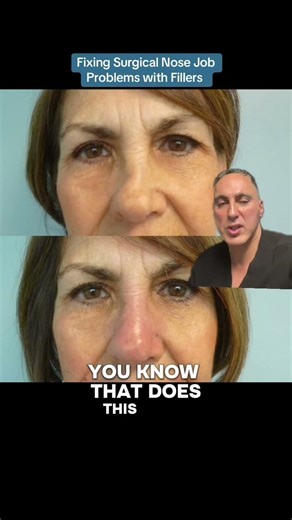 Fixing Surgical Nose Job Problems with Fillers