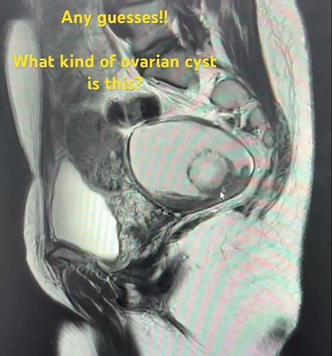 Ovarian Cyst Types Explained in 48 Seconds! #shorts