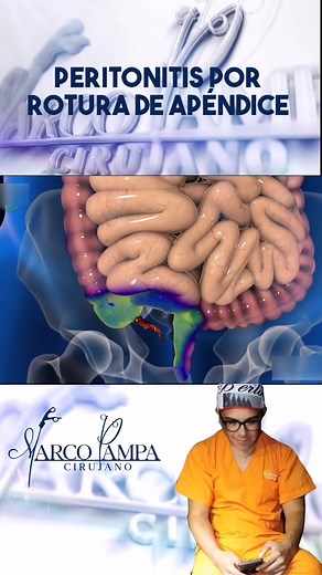 Understanding Peritonitis and Appendix Surgery: Causes and Treatments