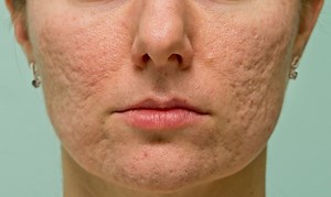 Do Acne Scar Removal Creams Really Work?