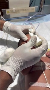 Putting eye drops in a newborn baby🥲👍 #youtubeshorts #nursing #newbornbaby #putting #eyes #drops