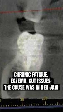 Chronic fatigue. Skin eczema. Gut problems.