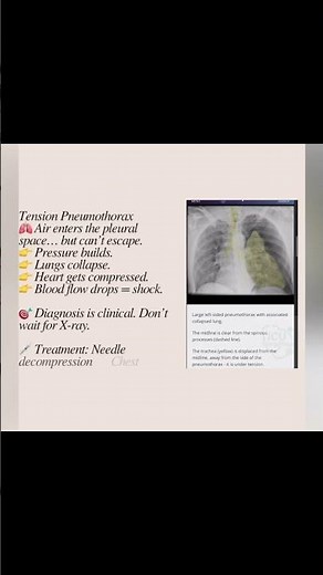 Tension pneumothorax pathophysiology