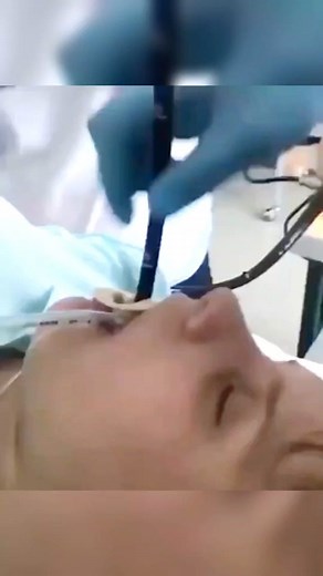 An endoscopy removing snake from a patients esophagus. Shared by @Dr. Joe, M.D. 🩺 😬🤮 #ERstories #snakes
