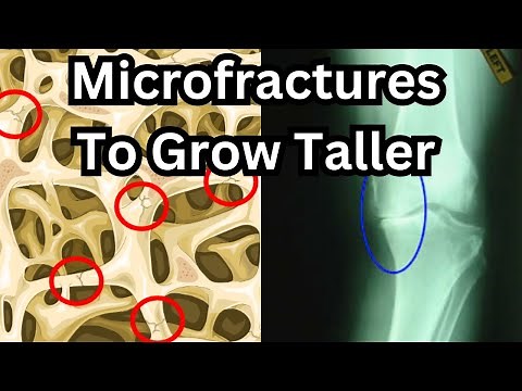 How To Grow Taller After Puberty: Full Microfracture Guide (with real-life examples)