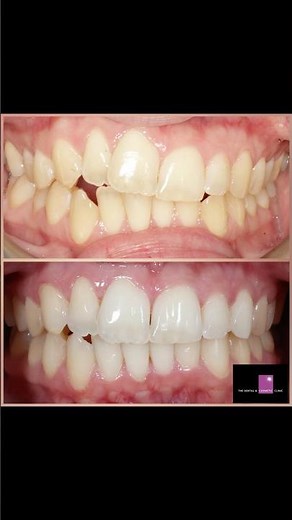 Dr Anoop Gill: Angel aligners case for 30 weeks to correct uneven occlusal plane cant #angelaligners