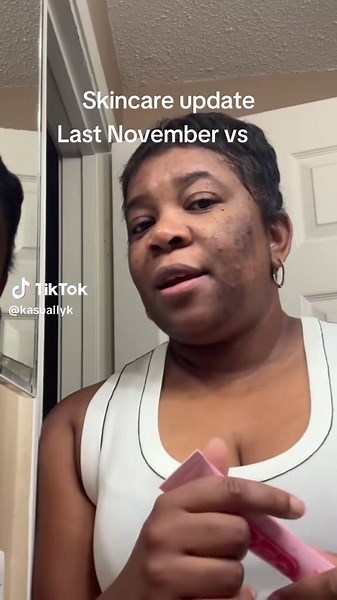 Skincare update. I’ve consistently used @TOPICALS for my hyperpigmentation over the last year and I am pleased with the results