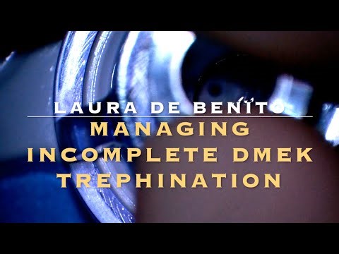 Managing an incomplete DMEK trephination