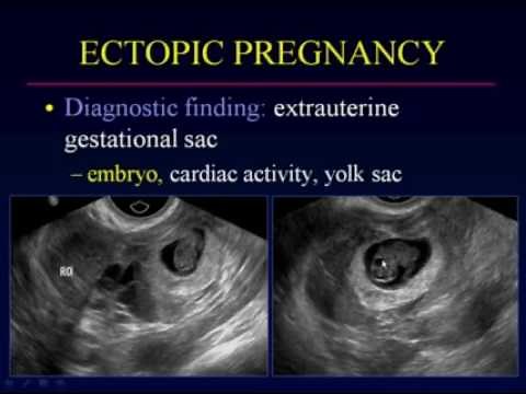 Sonographic Evaluation of Ectopic Pregnancy