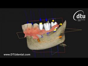 Carestream Dental CS Imaging Software 8 with CS 9600 CS 3600 implant meshing