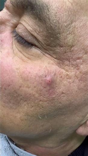 Blackheads pimple on the cheek Removal! 🧐