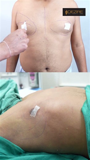 Gynecomastia Surgery