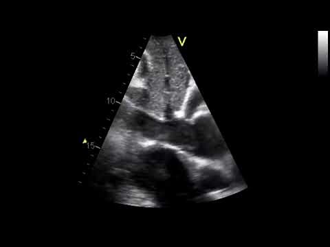 Constrictive Pericarditis | Pericardial Effusion