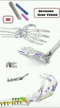 Osteomed - Hand Fusion #shorts #hand | biology with Aliya