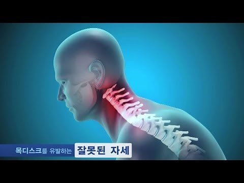 자생한방병원이 알려주는 목디스크 원인·증상·치료법