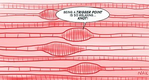 What is a Trigger Point