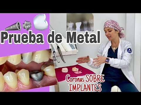 Prueba de Metal CORONAS SOBRE IMPLANTES #89