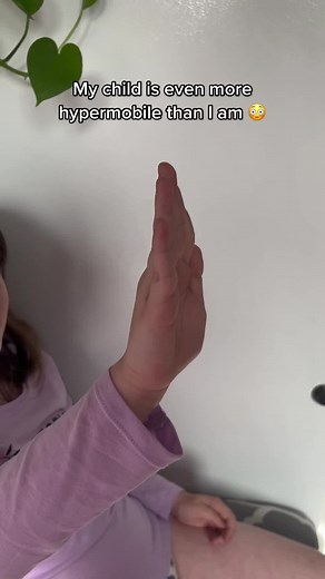 it is genetic #hypermobilitycheck #hsd #ehlersdanlos #heds #hypermobileehlersdanlossyndrome #geneticdisorder