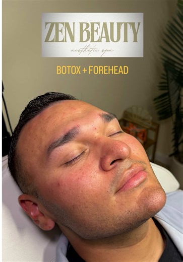 Watch my BOTOX process by Zen Beauty in the RGV 💉🧖‍♂️✨ 🗓️: BOOK & SCHEDULE a complimentary consultation or a treatment (956-800-7000) 📍: 5400 N Ware Rd, Suite 90 McAllen, TX 78504 ☎️: Call or schedule online - we make it easy. Because beauty like this shouldn’t wait! 🏩: THE BEST AT @Zen Beauty RGV 💉: ONE AND ONLY @Yolanda Anahi Esparza #956 #rgv #956valley #botox #facial