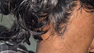 112K views · 881 reactions | Alopecia areata ophiasis | Dr. Khaled Hasan Milu | Facebook