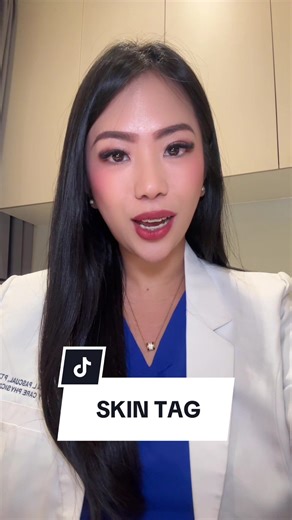 Understanding Skin Tags and Their Causes