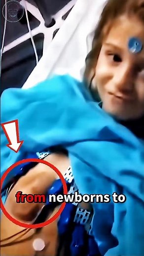 A Heart Beating OUTSIDE the Body? 🫀 (Ectopia Cordis)